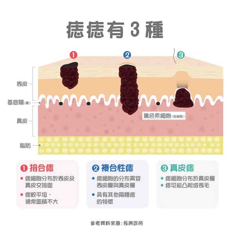 身體很多痣|痣形成的原因？痣長毛、痣變多變大是痣病變？5招判別